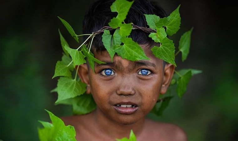 Waardenburg Sendromu Nedir? Hangi Genler Waardenburg Sendromuyla İlişkilidir?