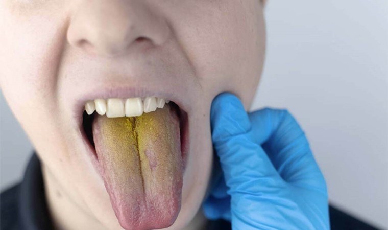 Diliniz aynada böyle görünüyorsa dikkat! Dildeki renk değişimi hangi hastalıkların habercisi?